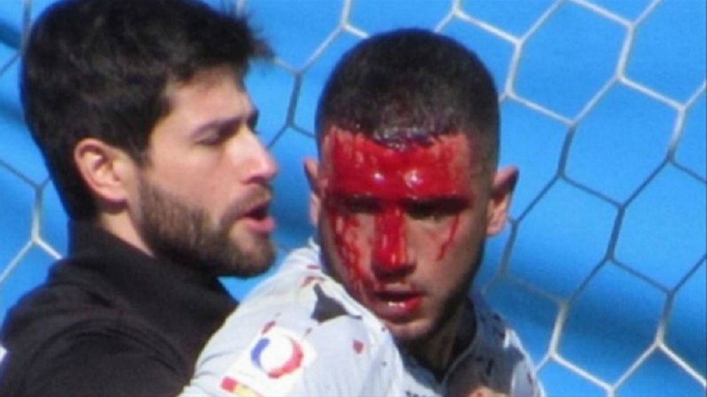 DEPORTE / ¡IMPACTANTE! PORTERO DE FÚTBOL MAURICIO VIANA DE SANTIAGO WANDERERS TERMINÓ CON CUATRO CORTES EN SU ROSTRO