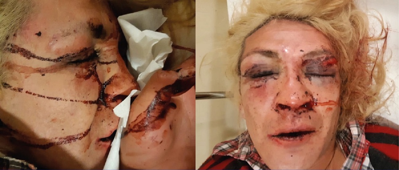  Brutal ataque en Puerto Montt | Desfiguran rostro de mujer trans