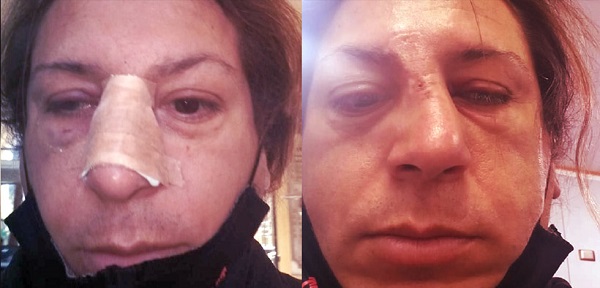 Ataque transfóbico: fracturan nariz de mujer trans en Peñalolén