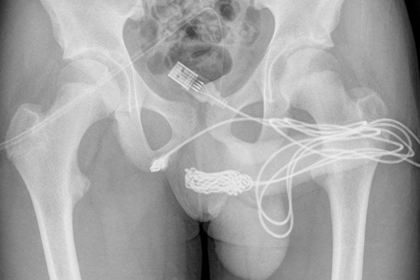 Un adolescente inserta un cable USB en su pene para medir qué tan largo era | Fotos